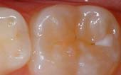 Sealant-Before - Pediatric Dentist in Duncan, SC and Spartanburg County